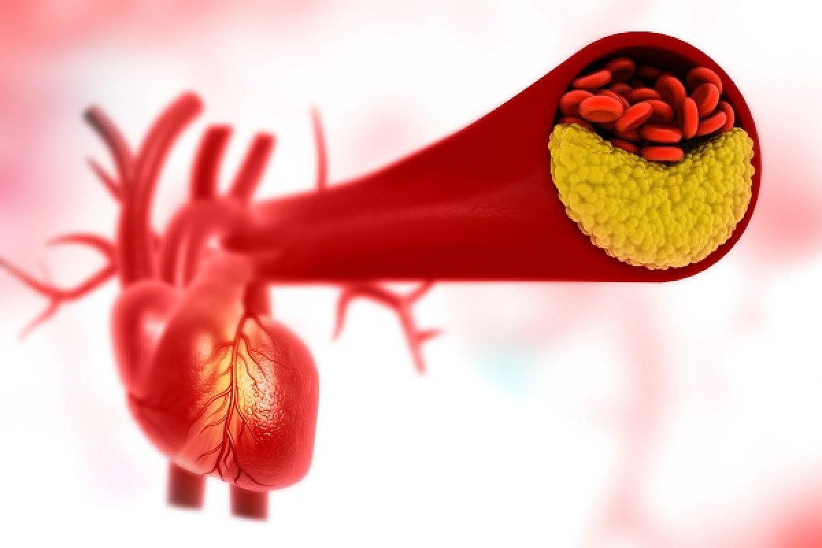 Nouvelle molécule cardioprotectrice TRO40303 dans l¹infarctus aigu du myocarde