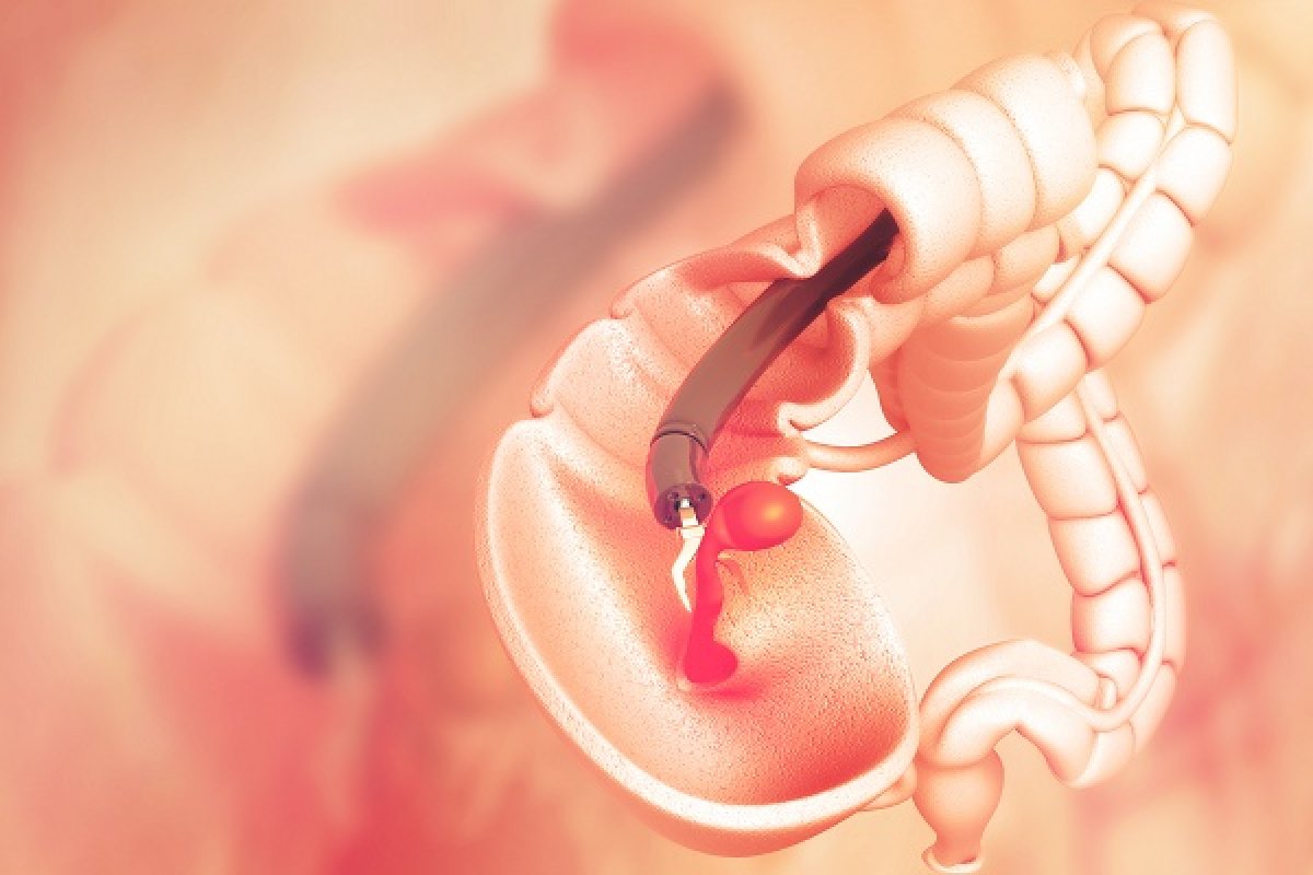 OncoMethylome Présente des Résultats Prometteurs de son Programme de Dépistage du Cancer Colorectal