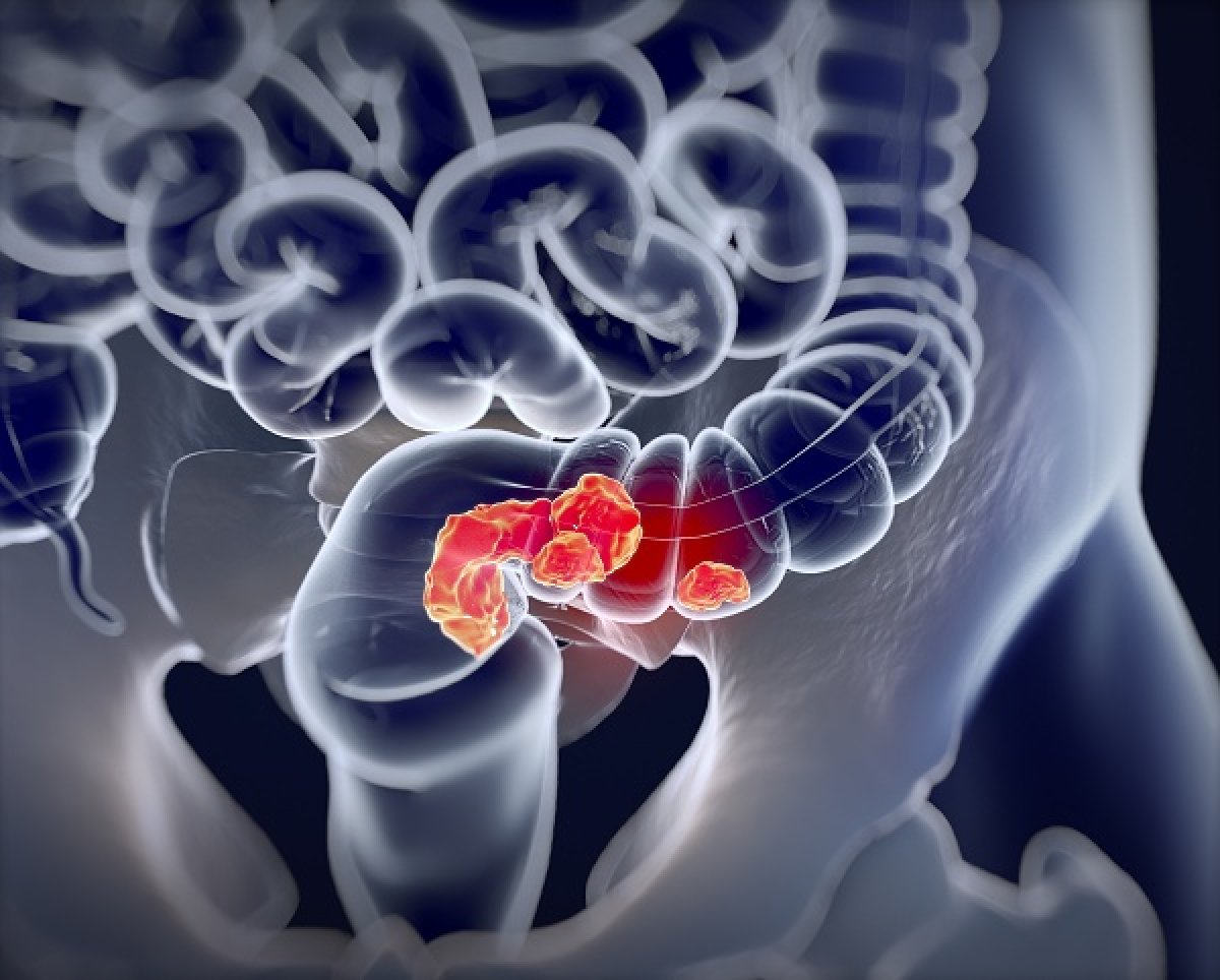 Valider un bio-marqueur dans le cancer colo-rectal métastatique